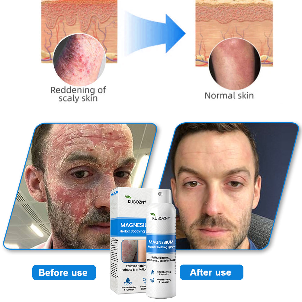 ⚕️ KUBOZN® Magnesium Herbal Psoriasis Spray ⚡3-MINUTE RELIEF